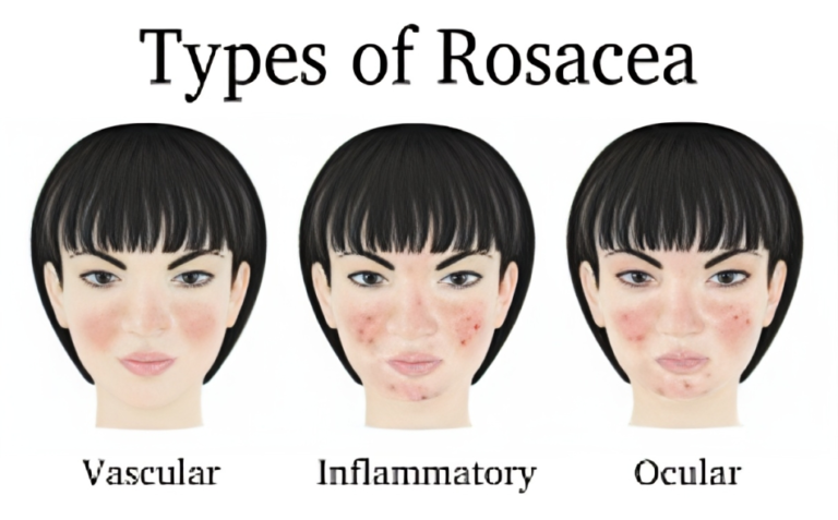 Rosacea